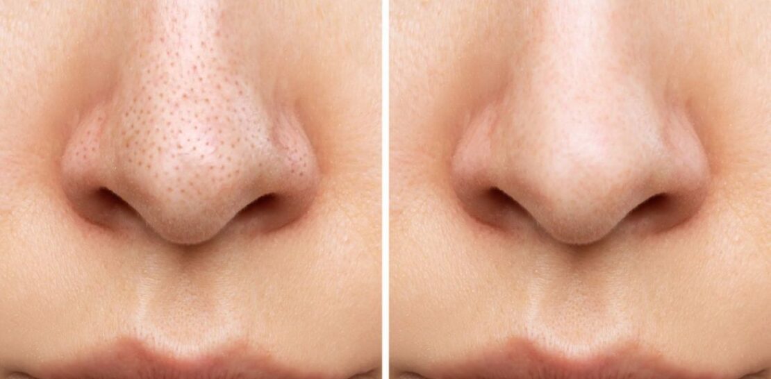 Unlock the Secret to Flawless Skin: 6 Expert Tips to Minimize Pores and Achieve Perfection